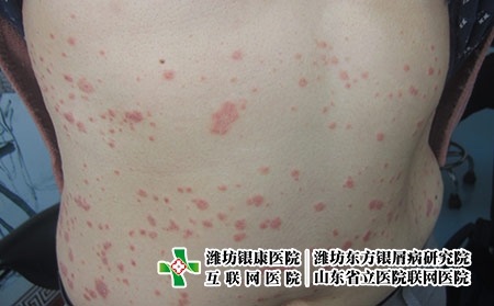 治療牛皮癬哪家醫(yī)院比較好，濰坊能看好牛皮癬么