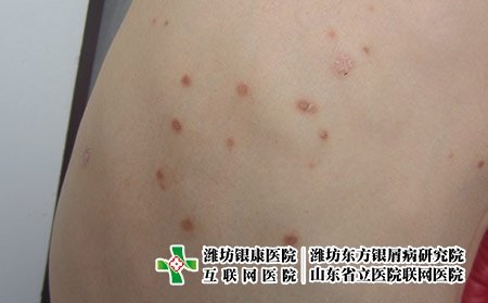 牛皮癬患者正確的洗澡方式，牛皮癬的日常皮膚清潔