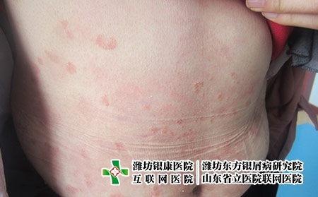 山東治療牛皮癬好的醫院在哪?濰坊東方醫院看牛皮癬好