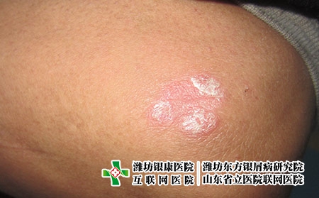濰坊看牛皮癬的醫院哪家好，濰坊東方專業專注