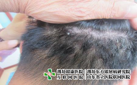 為什么牛皮癬患者會癢，牛皮癬瘙癢怎么辦