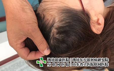 牛皮癬怎么治好的快，治療牛皮癬藥注意什么