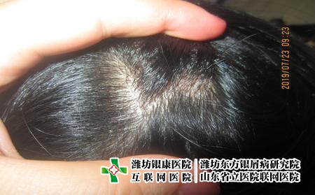 濰坊治牛皮癬的專業醫院怎么選，山東濰坊哪個醫院牛皮癬看得好