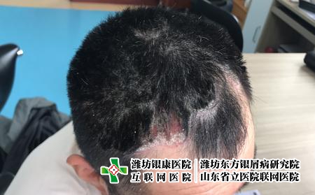 看牛皮癬的費用是多少，治療牛皮癬貴嗎