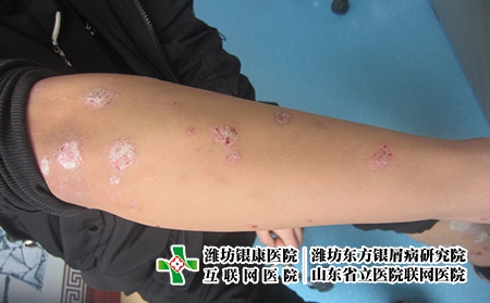 要怎么治療雙臂的牛皮癬,胳膊上有牛皮癬怎么辦好 要怎么治療雙臂的牛皮癬,胳膊上有牛皮癬怎么辦好