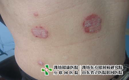 膿包型牛皮癬的類型有哪些，膿包型牛皮癬都有什么樣