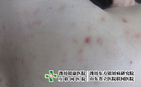 牛皮癬診斷的要點是什么，怎么分辨是不是牛皮癬