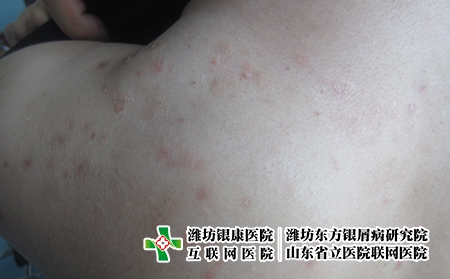 牛皮癬疾病如何治療好,怎么治牛皮癬才科學 牛皮癬疾病如何治療好,怎么治牛皮癬才科學