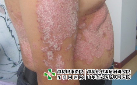 濰坊看牛皮癬的費(fèi)用是多少，濰坊東方治療費(fèi)用貴不貴