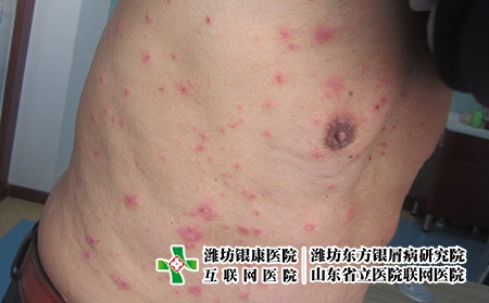 牛皮癬患者的飲食須知，牛皮癬應(yīng)該多吃什么