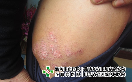 牛皮癬三個時期有什么樣的表現，牛皮癬的階段變化