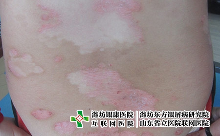 濰坊好的牛皮癬醫院是怎樣的，濰坊哪個醫院治牛皮癬專業