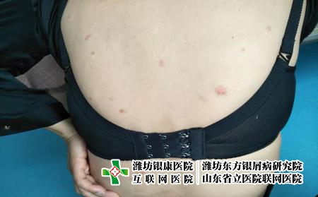 準(zhǔn)媽媽患上了牛皮癬要怎么辦，孕婦牛皮癬要注意什么