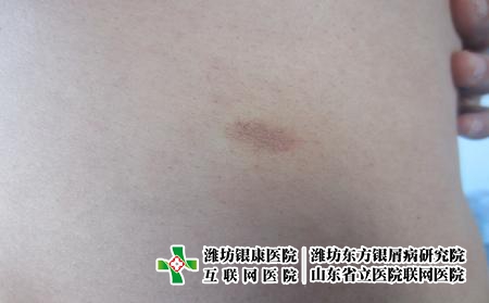 牛皮癬發病機制，什么會導致牛皮癬發作