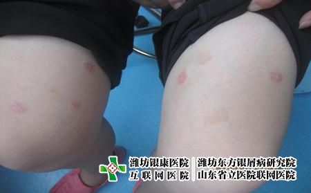 牛皮癬平時的護理怎么做，牛皮癬生活中注意什么