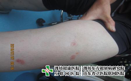 牛皮癬不及時(shí)治療會(huì)有什么危害，為什么牛皮癬要科學(xué)治療