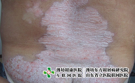 治療牛皮癬要花多少錢，濰坊東方治牛皮癬貴嗎