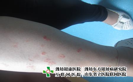 牛皮癬季節護理，牛皮癬患者生活中注意什么