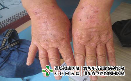 牛皮癬患者治療期間要注意什么，牛皮癬怎么恢復的快