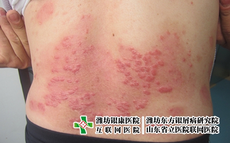 尋常型牛皮癬是什么癥狀，什么樣的癬是牛皮癬