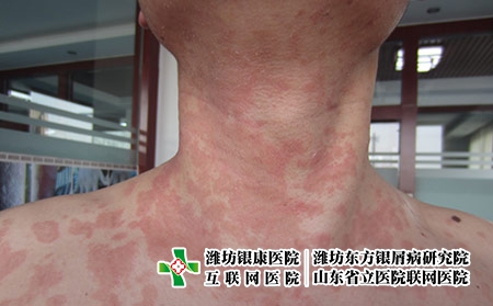 尋常型牛皮癬剛開始什么樣，怎么看是不是牛皮癬