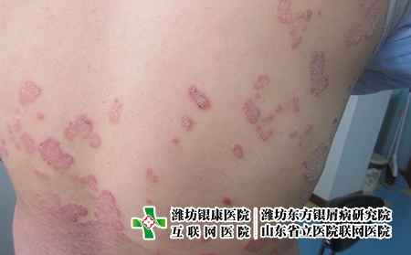 濰坊治療牛皮癬的醫(yī)院哪家正規(guī)，濰坊看牛皮癬去哪里