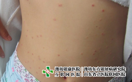 濰坊哪里治療牛皮癬好，濰坊比較專業的牛皮癬醫院