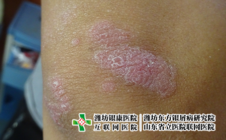 牛皮癬如何做好預防,牛皮癬好了怎么防止再次發作 牛皮癬如何做好預防,牛皮癬好了怎么防止再次發作