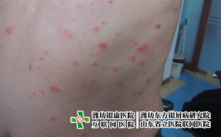 哪些癥狀表現可以看出得了牛皮癬，什么是牛皮癬