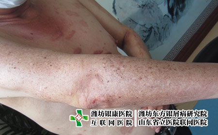 牛皮癬關(guān)節(jié)炎是怎么回事，牛皮癬會(huì)導(dǎo)致關(guān)節(jié)炎嗎