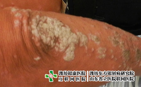 每天泡澡對牛皮癬好嗎，牛皮癬怎么洗浴