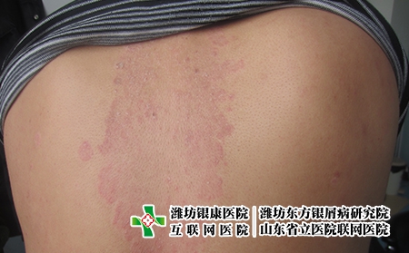 男性牛皮癬患者要做好哪些護理,男性牛皮癬要注意什么 男性牛皮癬患者要做好哪些護理,男性牛皮癬要注意什么