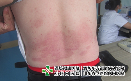 濰坊哪里治牛皮癬比較好，濰坊東方好嗎