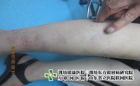 牛皮癬如何治療好的快，牛皮癬治療要注意什么