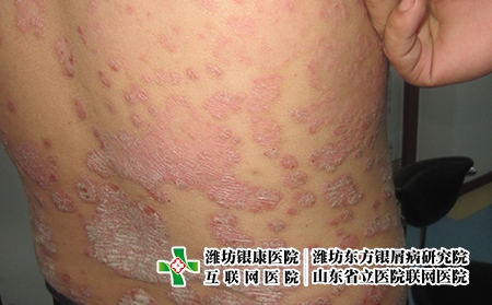 膿皰型牛皮癬如何護理，嚴重的牛皮癬要注意什么