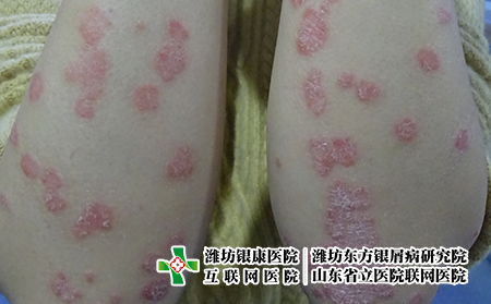 牛皮癬怎么治的治療費用少，牛皮癬治療怎么少花錢