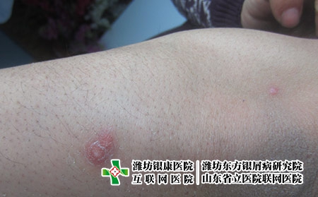 怎樣治療關(guān)節(jié)型牛皮癬效果才好，牛皮癬關(guān)節(jié)炎怎么治