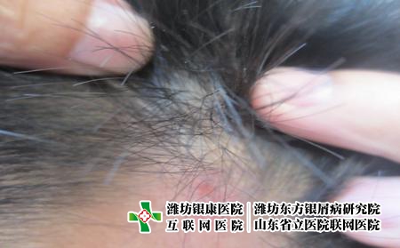 頭部牛皮癬會產生脫發嗎，牛皮癬長頭上怎么回事