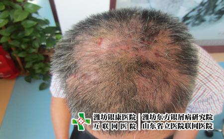 牛皮癬為什么會反復發作呢，什么導致牛皮癬發作