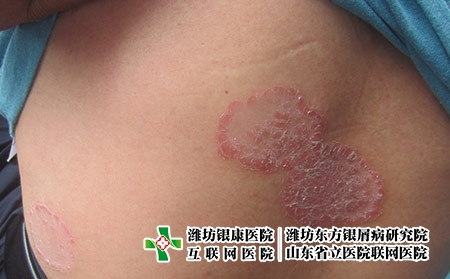 看牛皮癬到哪家醫院比較好，濰坊東方好口碑