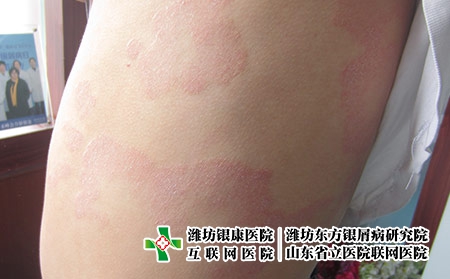 牛皮癬患者夏季睡眠注意事項，牛皮癬的季節護理