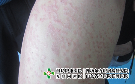 治療牛皮癬的費用是多少，想治療牛皮癬貴不貴