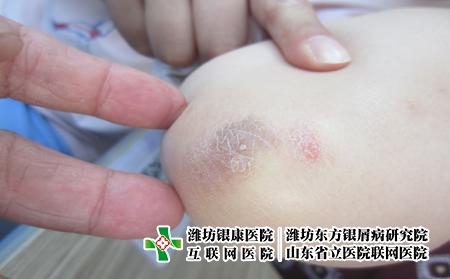 在濰坊治療牛皮癬的費用多不多，頑固牛皮癬治療貴嗎