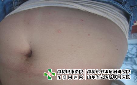 牛皮癬的護(hù)理方法有哪些，牛皮癬患者平時(shí)怎么做