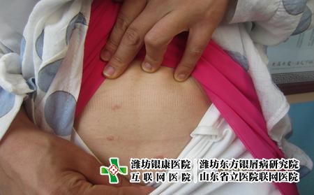 在濰坊治療牛皮癬大概需要花多少錢。治療牛皮癬貴不貴