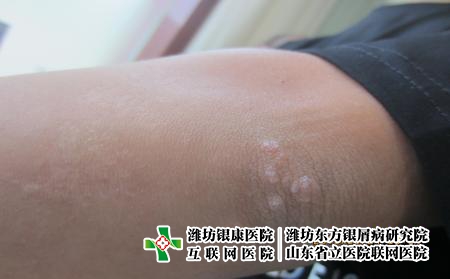 治療牛皮癬需要遵循什么原則,怎么科學治牛皮癬 治療牛皮癬需要遵循什么原則,怎么科學治牛皮癬