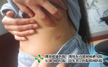 牛皮癬不可擅自治療，得了牛皮癬怎么辦