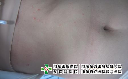 牛皮癬治療價格是多少，正規醫院治牛皮癬花多少錢