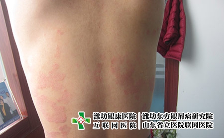 濰坊看牛皮癬要多少錢,濰坊東方治牛皮癬貴嗎 濰坊看牛皮癬要多少錢,濰坊東方治牛皮癬貴嗎