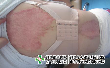 濰坊牛皮癬治療哪家好，看牛皮癬到哪個醫院